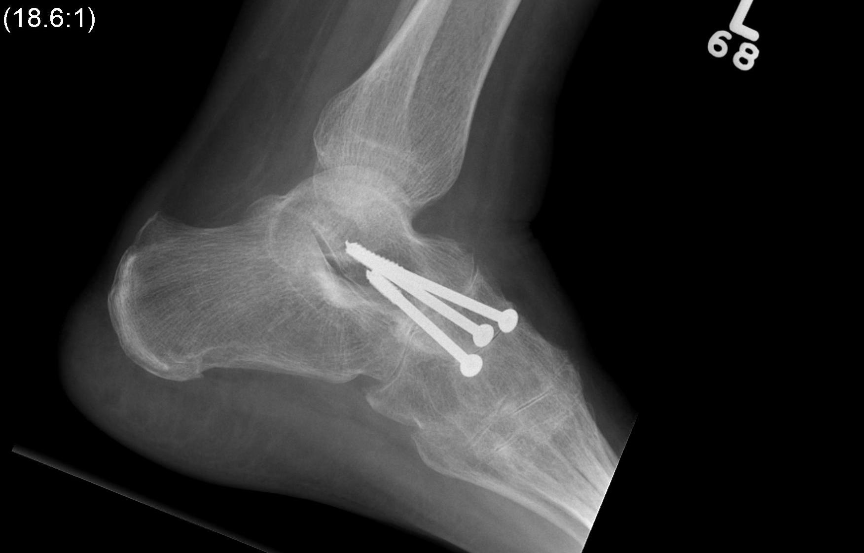 Rheumatoid TNJ Fusion Lateral